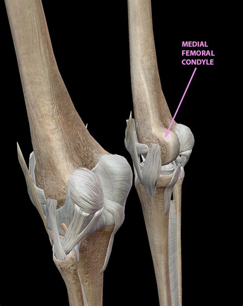 crown of femurs|medial femoral condyle.